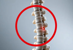 Spondylose verstehen und den Rücken stärken