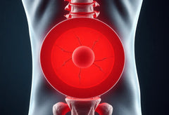 Discus prolaps verstehen und behandeln: Ihr Weg zur Schmerzfreiheit